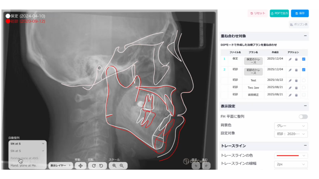矯正歯科の「重ね合わせ」をAIで自動化｜クラウド型AIセファロ分析「DIP Magic Compare」正式リリース